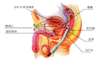 曼迪前列腺治療儀 治療機理