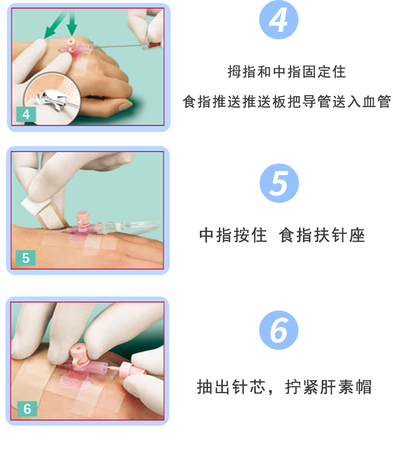 沃素安24G动静脉留置针