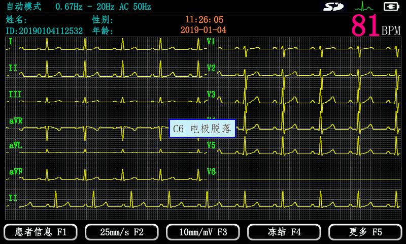心电图机 EM-301心电图机 数字心电图机